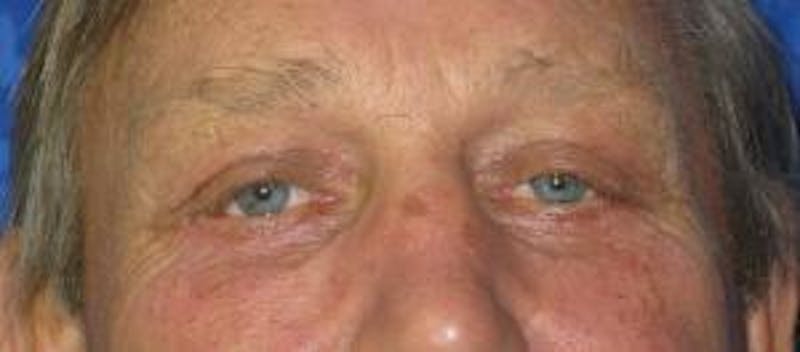 Blepharoplasty (Eyelids) Before & After Gallery - Patient 353758 - Image 2