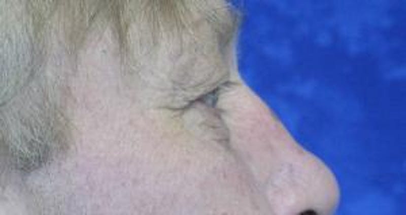 Blepharoplasty (Eyelids) Before & After Gallery - Patient 353758 - Image 3
