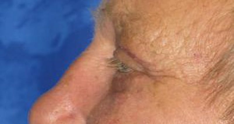 Blepharoplasty (Eyelids) Before & After Gallery - Patient 353758 - Image 4