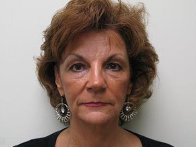 Blepharoplasty (Eyelids) Before & After Gallery - Patient 308477 - Image 1