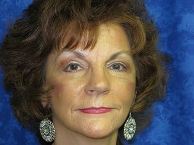 Blepharoplasty (Eyelids) Before & After Gallery - Patient 308477 - Image 2