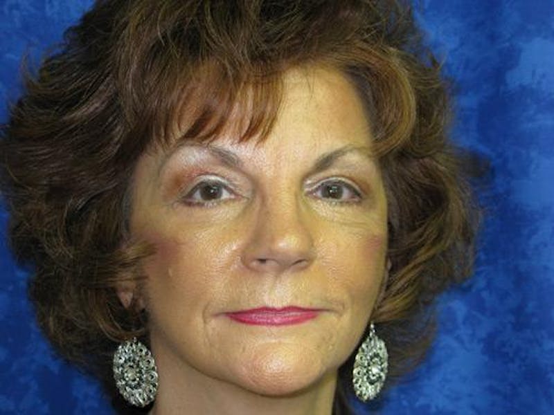 Blepharoplasty (Eyelids) Before & After Gallery - Patient 308477 - Image 2