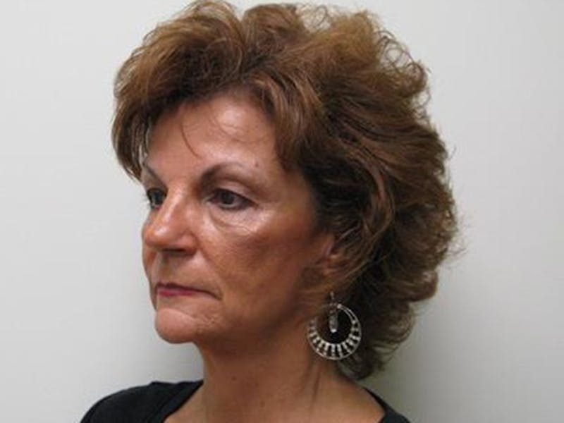 Blepharoplasty (Eyelids) Before & After Gallery - Patient 308477 - Image 3