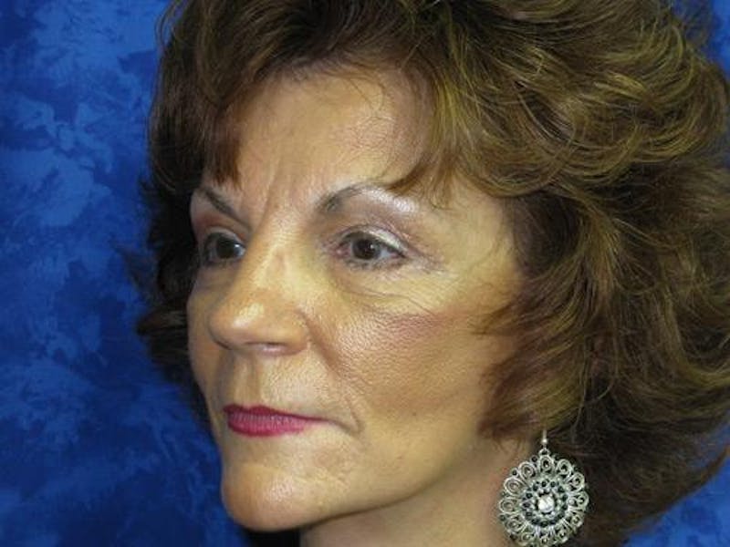 Blepharoplasty (Eyelids) Before & After Gallery - Patient 308477 - Image 4