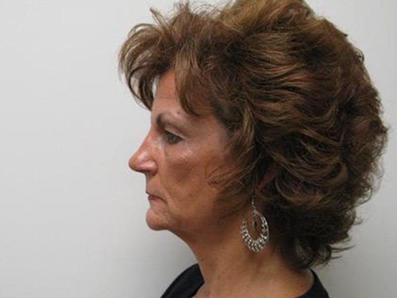 Blepharoplasty (Eyelids) Before & After Gallery - Patient 308477 - Image 5