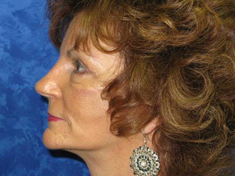 Blepharoplasty (Eyelids) Before & After Gallery - Patient 308477 - Image 6