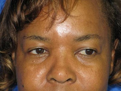 Blepharoplasty (Eyelids) Before & After Gallery - Patient 167768 - Image 1