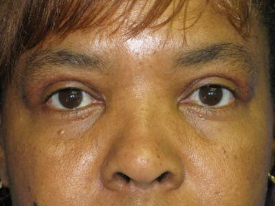 Blepharoplasty (Eyelids) Before & After Gallery - Patient 167768 - Image 2