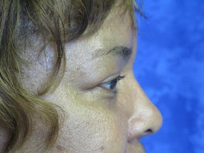 Blepharoplasty (Eyelids) Before & After Gallery - Patient 167768 - Image 3