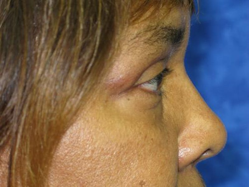 Blepharoplasty (Eyelids) Before & After Gallery - Patient 167768 - Image 4