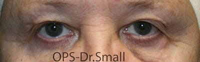 Blepharoplasty (Eyelids) Before & After Gallery - Patient 757945 - Image 1