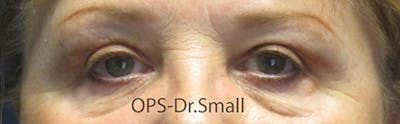 Blepharoplasty (Eyelids) Before & After Gallery - Patient 757945 - Image 2