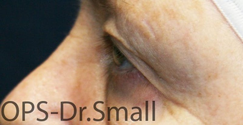 Blepharoplasty (Eyelids) Before & After Gallery - Patient 757945 - Image 3