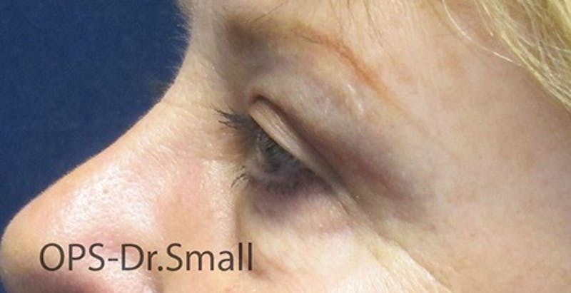 Blepharoplasty (Eyelids) Before & After Gallery - Patient 757945 - Image 4
