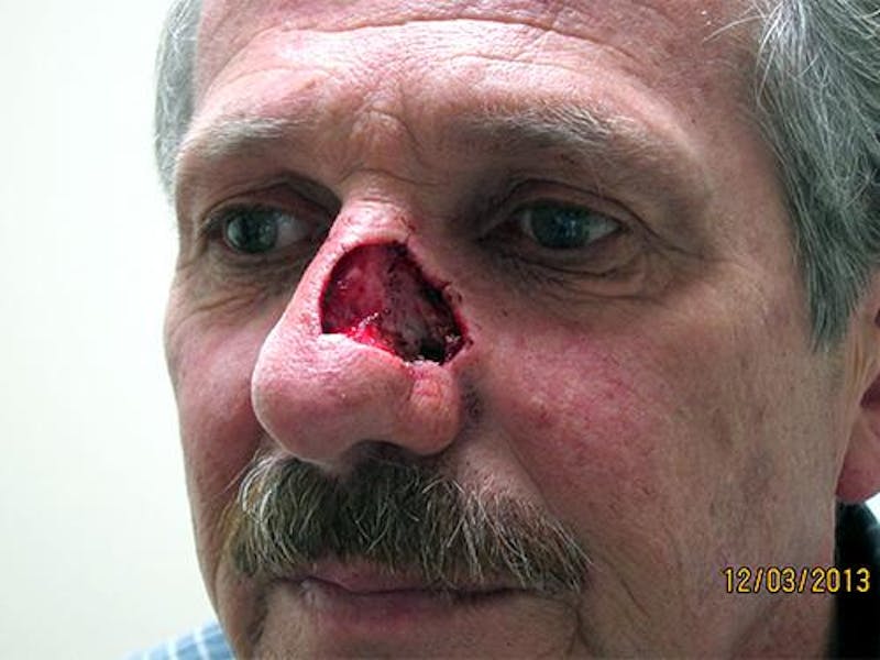 Face Reconstructive Before & After Gallery - Patient 521962 - Image 1