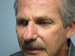 Face Reconstructive Before & After Gallery - Patient 521962 - Image 2
