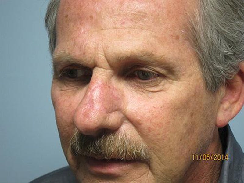 Face Reconstructive Before & After Gallery - Patient 521962 - Image 2