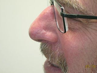 Face Reconstructive Before & After Gallery - Patient 521962 - Image 4