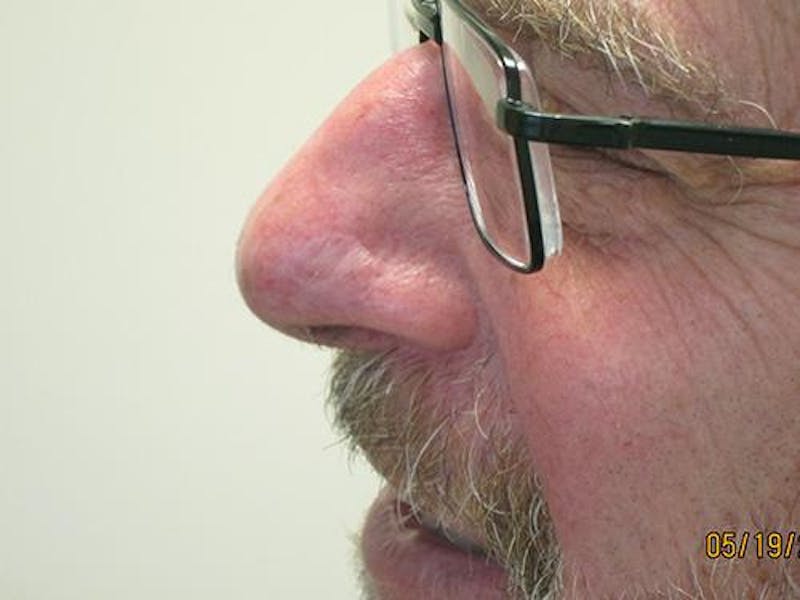 Face Reconstructive Before & After Gallery - Patient 521962 - Image 4