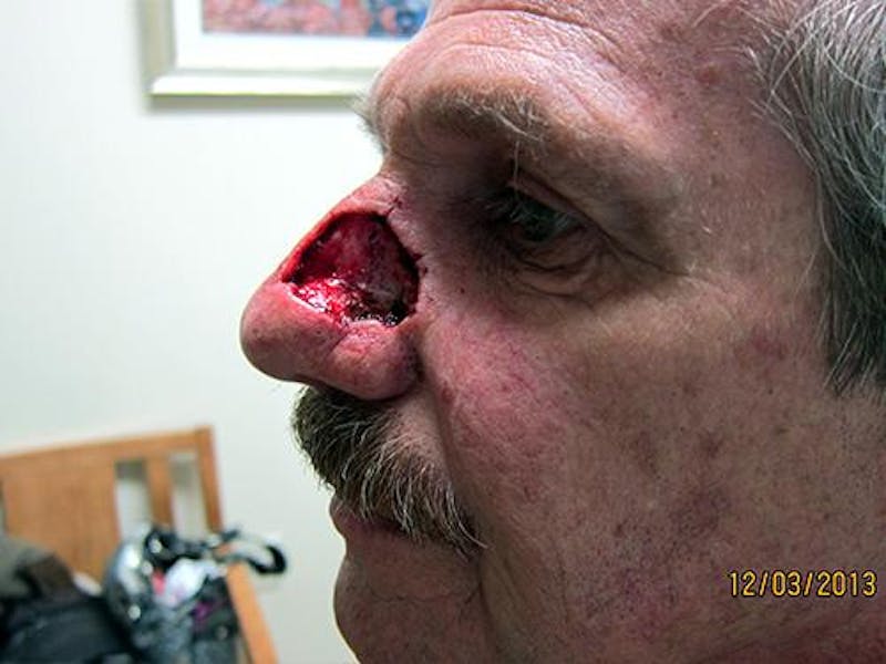 Face Reconstructive Before & After Gallery - Patient 521962 - Image 5