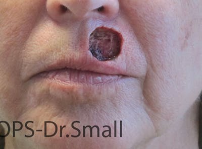 Face Reconstructive Before & After Gallery - Patient 349335 - Image 1