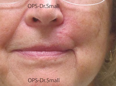 Face Reconstructive Before & After Gallery - Patient 349335 - Image 2