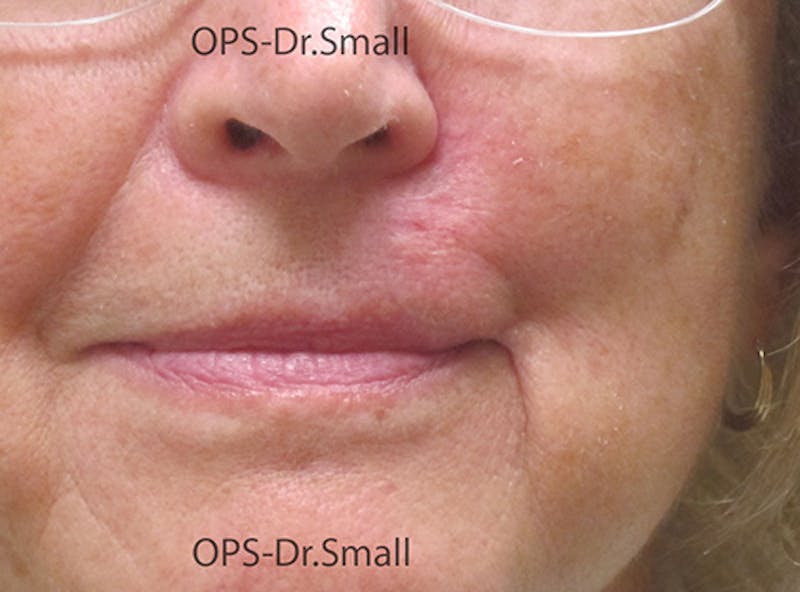 Face Reconstructive Before & After Gallery - Patient 349335 - Image 2