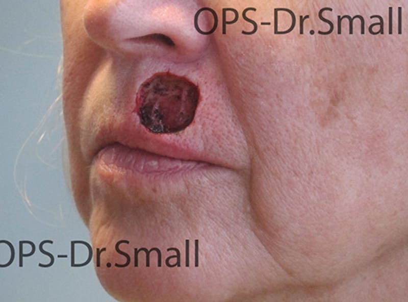 Face Reconstructive Before & After Gallery - Patient 349335 - Image 3