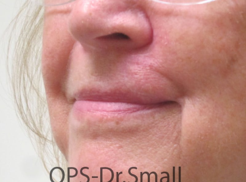 Face Reconstructive Before & After Gallery - Patient 349335 - Image 4