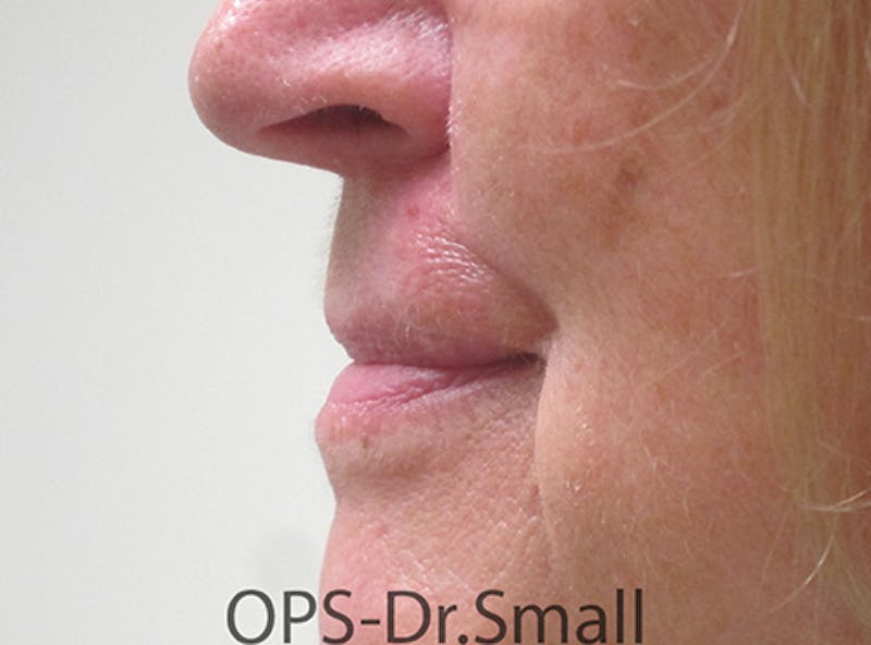 Face Reconstructive Before & After Gallery - Patient 349335 - Image 6