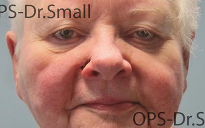 Face Reconstructive Before & After Gallery - Patient 145567 - Image 1