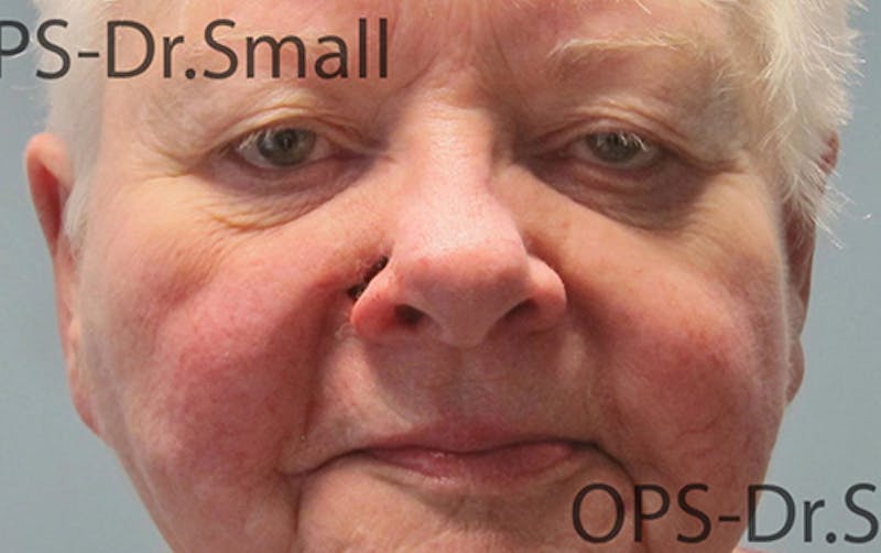 Face Reconstructive Before & After Gallery - Patient 145567 - Image 1
