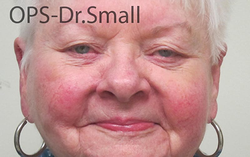 Face Reconstructive Before & After Gallery - Patient 145567 - Image 2