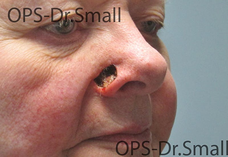Face Reconstructive Before & After Gallery - Patient 145567 - Image 3