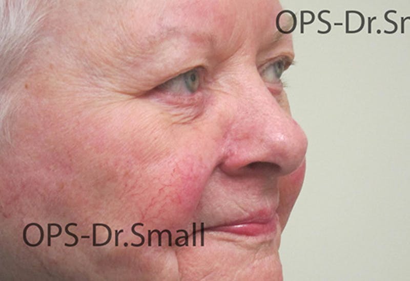 Face Reconstructive Before & After Gallery - Patient 145567 - Image 4