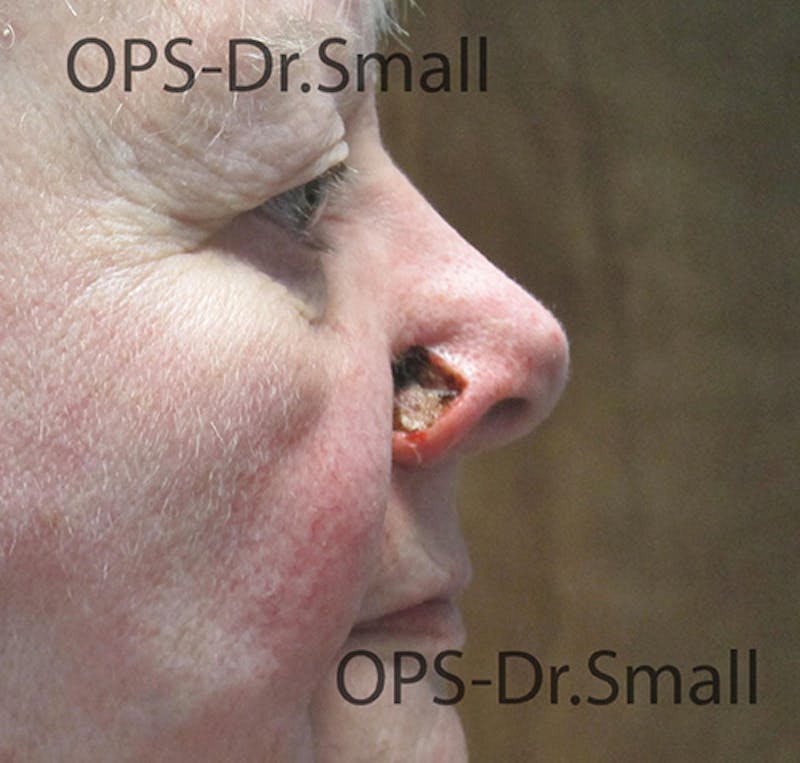 Face Reconstructive Before & After Gallery - Patient 145567 - Image 5