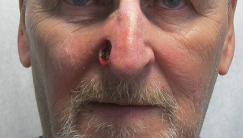 Face Reconstructive Before & After Gallery - Patient 995463 - Image 1