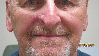 Face Reconstructive Before & After Gallery - Patient 995463 - Image 2