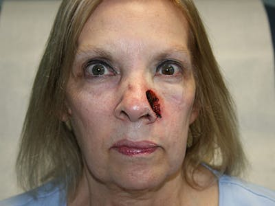 Face Reconstructive Before & After Gallery - Patient 280452 - Image 1