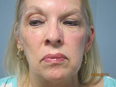 Face Reconstructive Before & After Gallery - Patient 280452 - Image 2