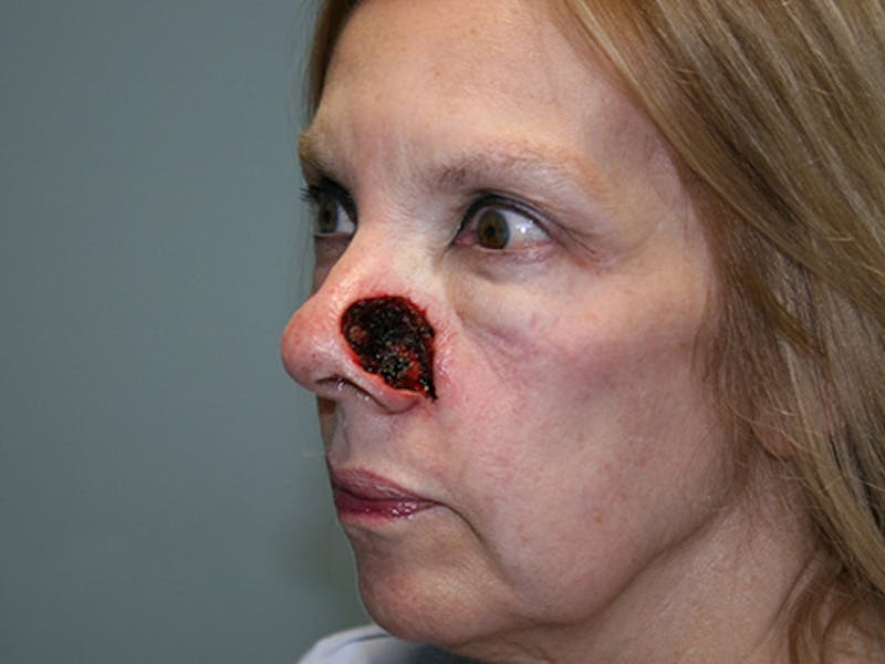 Face Reconstructive Before & After Gallery - Patient 280452 - Image 3