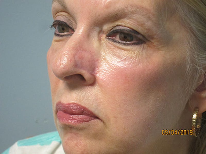 Face Reconstructive Before & After Gallery - Patient 280452 - Image 4