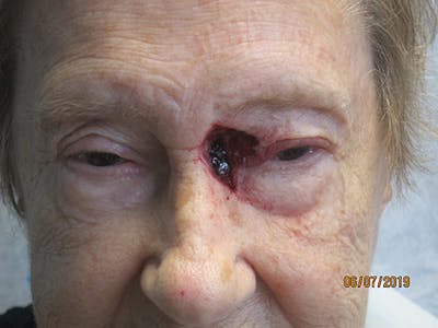 Face Reconstructive Before & After Gallery - Patient 165890 - Image 1