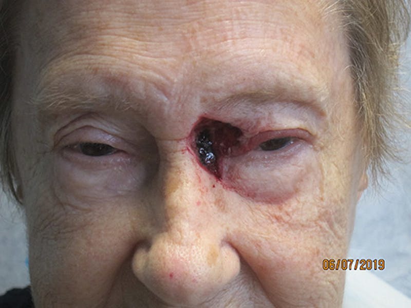 Face Reconstructive Before & After Gallery - Patient 165890 - Image 1