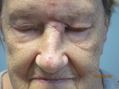Face Reconstructive Before & After Gallery - Patient 165890 - Image 2