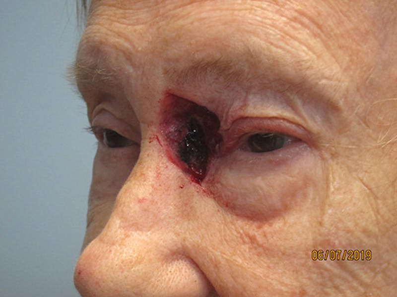 Face Reconstructive Before & After Gallery - Patient 165890 - Image 3