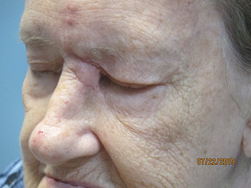 Face Reconstructive Before & After Gallery - Patient 165890 - Image 4