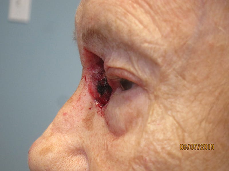Face Reconstructive Before & After Gallery - Patient 165890 - Image 5