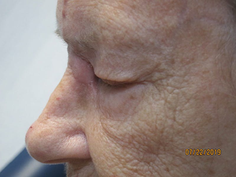 Face Reconstructive Before & After Gallery - Patient 165890 - Image 6
