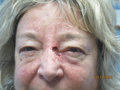 Face Reconstructive Before & After Gallery - Patient 428084 - Image 1